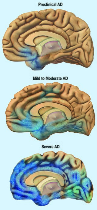 Brain with Alzheimer image