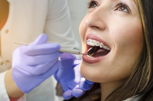 How Long Do You Have to Wear Braces to See Results?