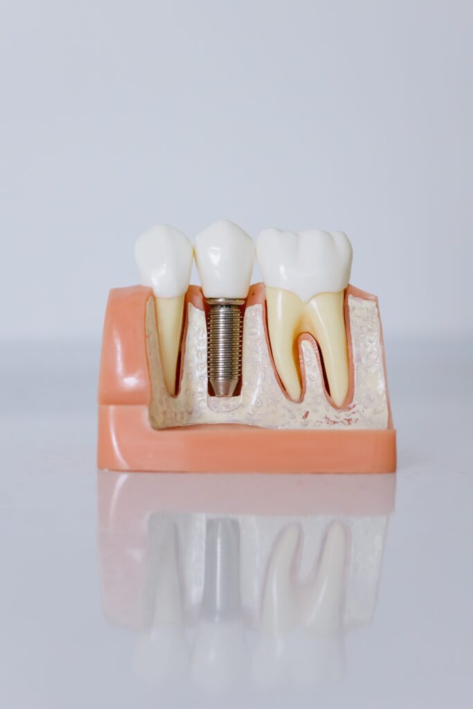 A dental implant model image