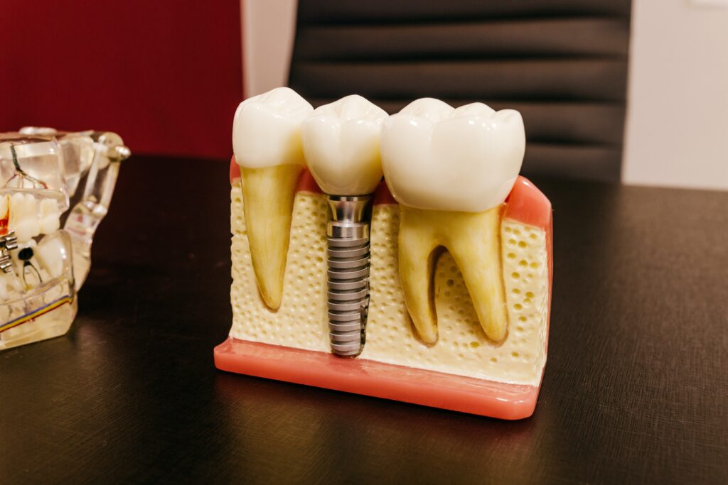 Dental implants with screw on table in clinic image