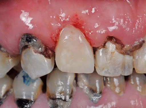 Dental caries closeup image