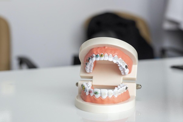 Reasons Why You Should Visit an Orthodontist
