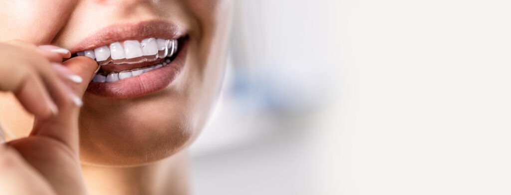  A smiling woman putting on a teeth aligner