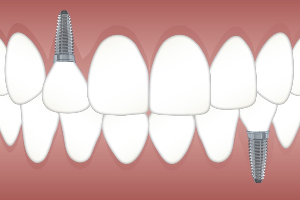 A set of teeth with dental implants