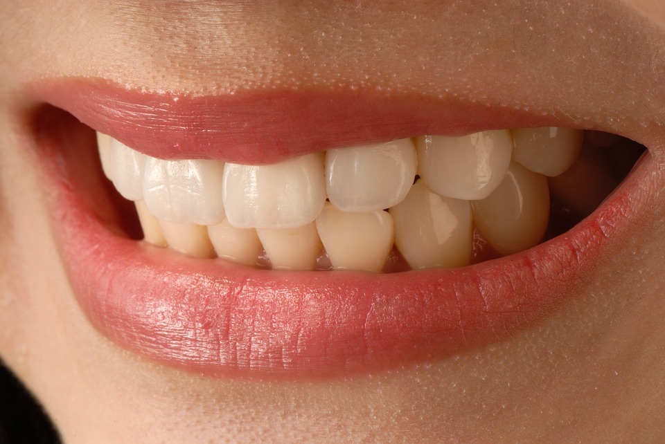 Porcelain Veneers What Are They