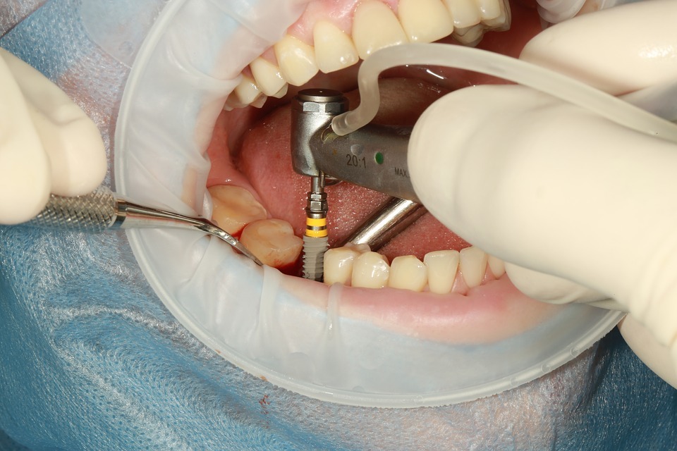 The Benefits of Dental Implants over Dentures