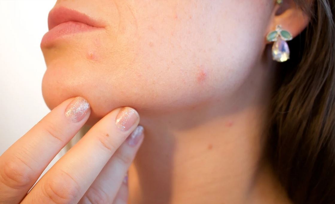What Causes Acne Spots Various Types of Acne and How to Prevent Them