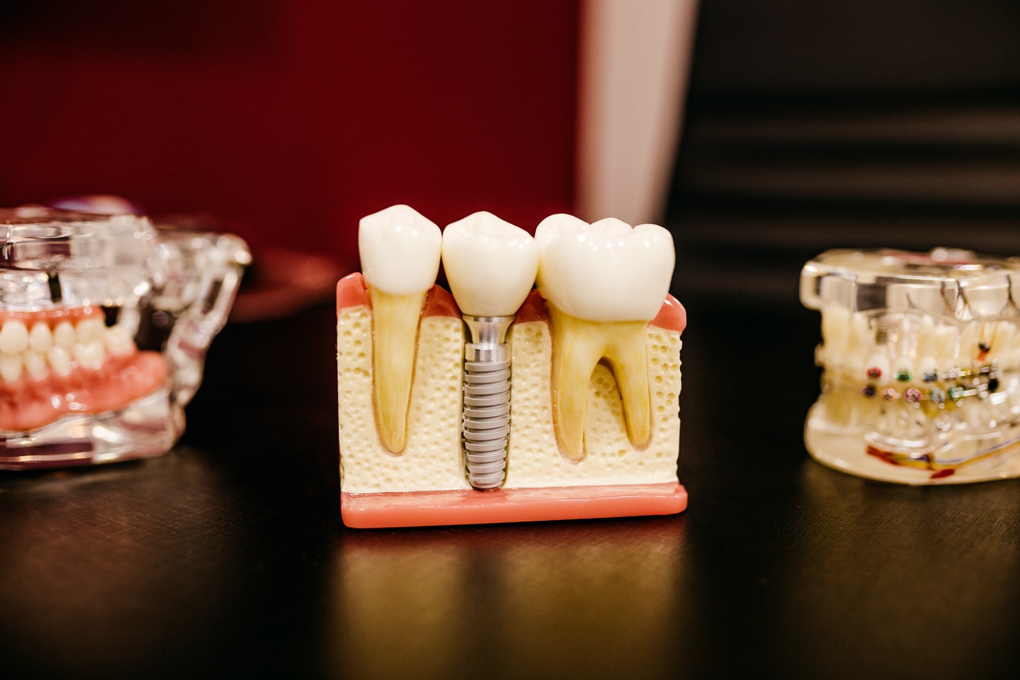5 Options For Replacing A Missing Tooth