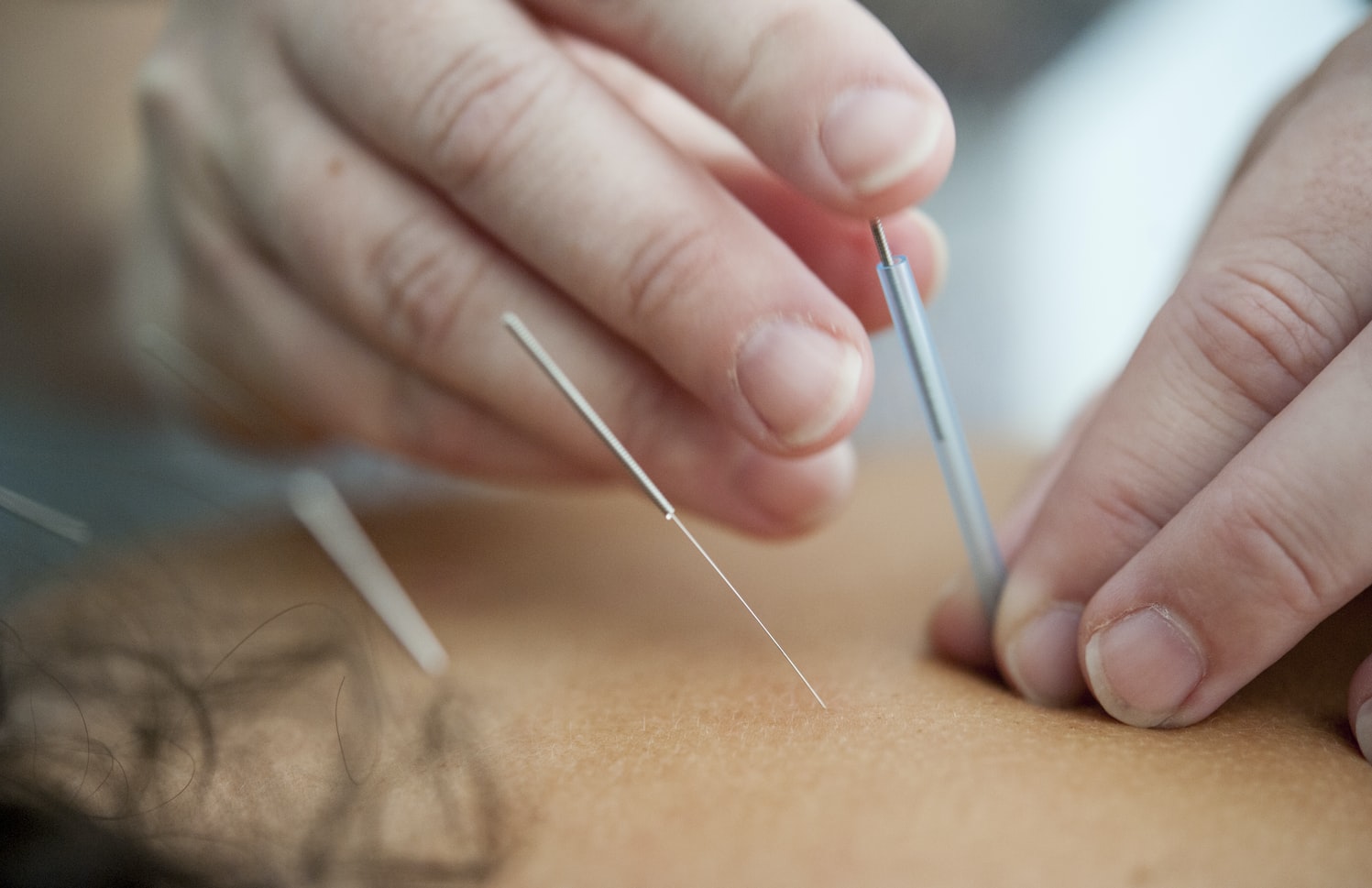 What is Acupuncture and How It Can Help You