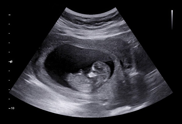 Echocardiography of the fetus