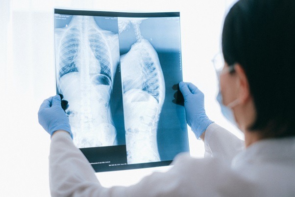 Types and Treatment Options for Mesothelioma