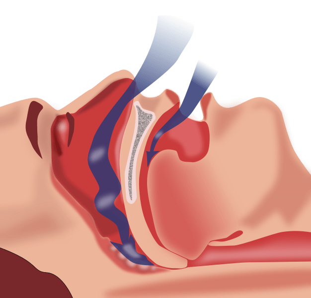 An image of  sleep apnea