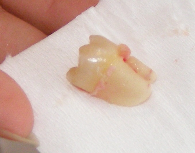 Extracted wisdom tooth that was horizontally impacted