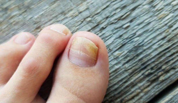 How Can I Tell If My Fungal Toenail Is Healing
