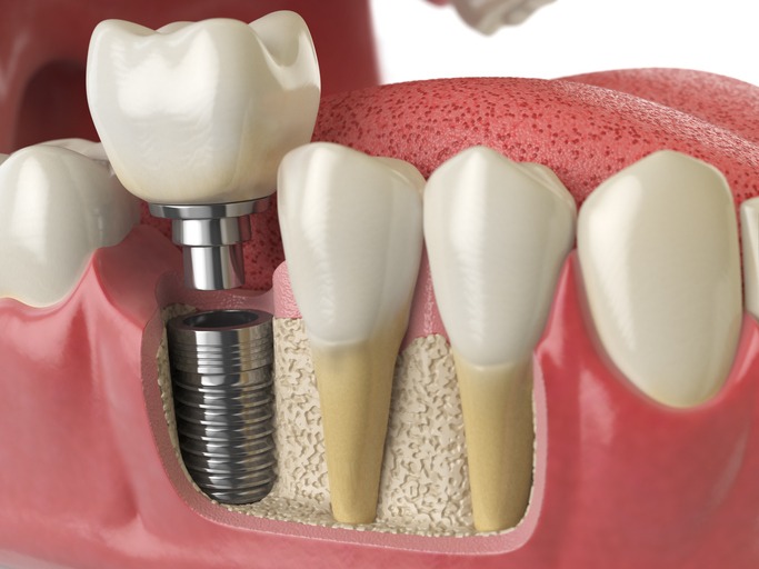 Oral Health Benefits of Tooth Implants