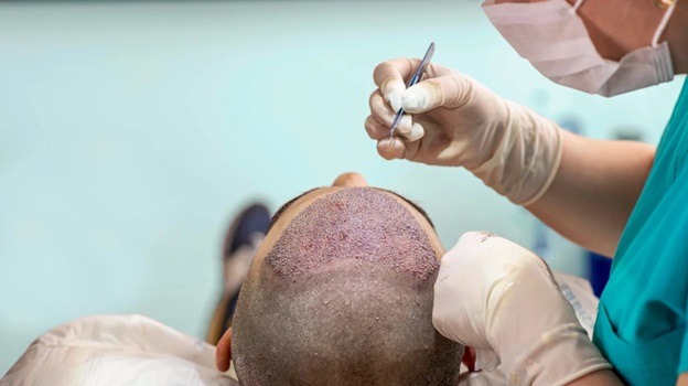 Factors to consider before you decide if a hair transplant is right for you