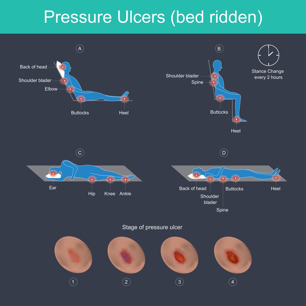 an illustration that shows where pressure ulcers are most likely to develop