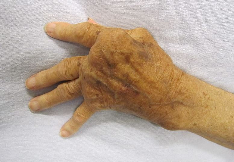 Alleviates-Rheumatoid-Arthritis